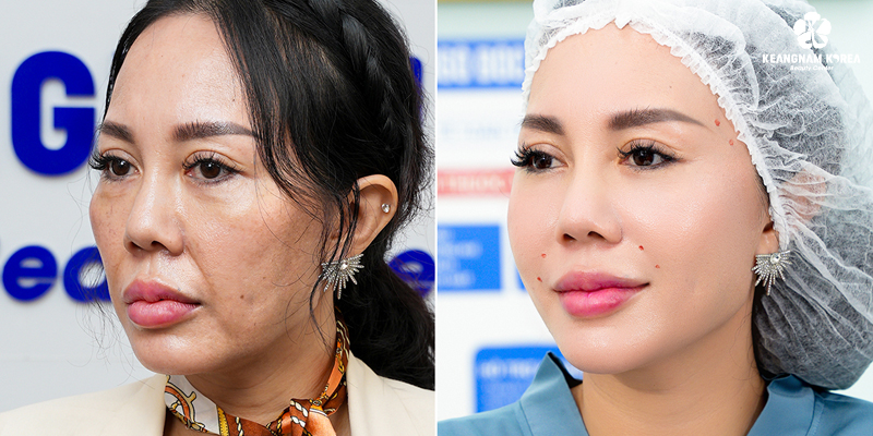 Smile Lines Treatment Cost in Ho Chi Minh: 2026 Price Guide for Deep Smile Lines and Mouth Wrinkles 4 Endoscopic Muscle Lift: Before and after