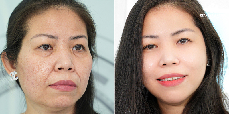 Smile Lines Treatment Cost in Ho Chi Minh: 2026 Price Guide for Deep Smile Lines and Mouth Wrinkles 3 Reborn Cell Extra+: Before and after