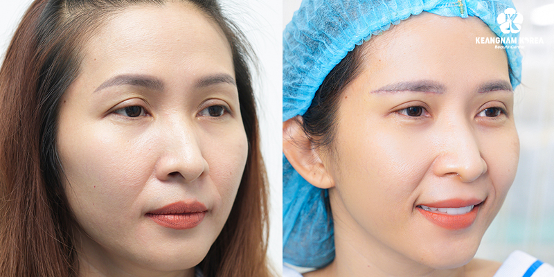 Upper Eyelid Surgery vs brow Lift: Which Procedure Looks Better and Lasts Longer? 2 Pros and Cons of Surgical Brow Lift
