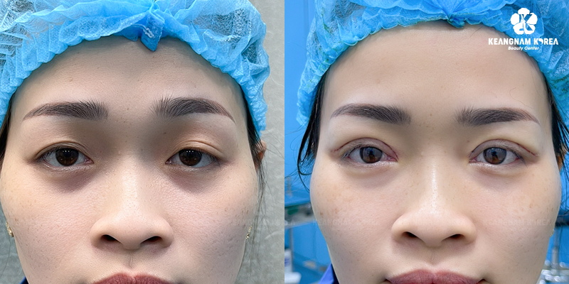 Upper Eyelid Surgery vs brow Lift: Which Procedure Looks Better and Lasts Longer? 3 upper eyelid surgery vs brow lift