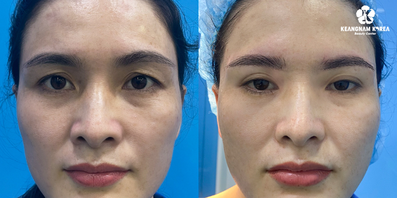 Upper Eyelid Surgery vs brow Lift: Which Procedure Looks Better and Lasts Longer? 4 upper eyelid surgery vs eyebrow lift