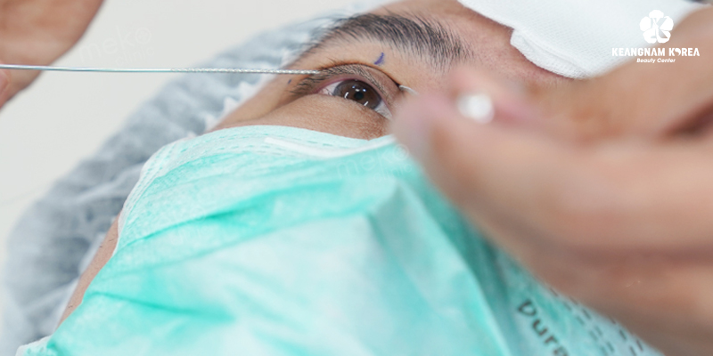 Upper Eyelid Surgery vs brow Lift: Which Procedure Looks Better and Lasts Longer? 5 upper eyelid surgery or eyebrow lift 4