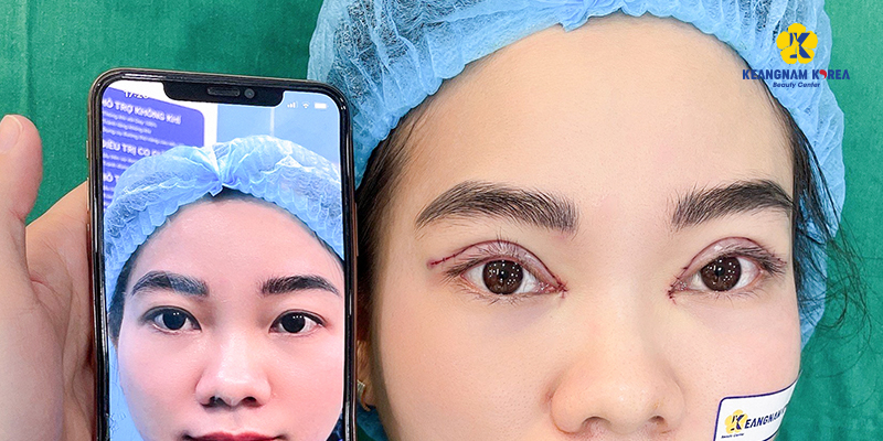 Upper Eyelid Surgery vs brow Lift: Which Procedure Looks Better and Lasts Longer? 1 Pros and Cons of Upper Eyelid Lift