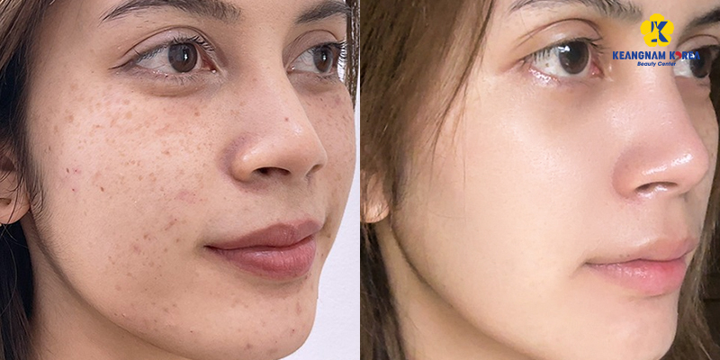 Best Treatment for Melasma on Face in Ho Chi Minh City: Spa vs Dermatologist vs Aesthetic Clinic, Where Should You Go? 5 Best Treatment for Melasma on Face in Ho Chi Minh City