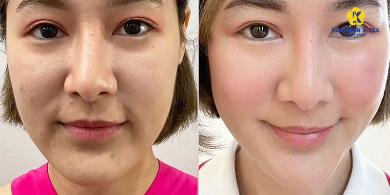 Best Treatment for Melasma on Face in Ho Chi Minh City: Spa vs Dermatologist vs Aesthetic Clinic, Where Should You Go? 6 Best Treatment for Melasma on Face in Ho Chi Minh City