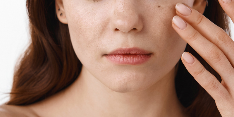 Best Treatment for Melasma on Face in Ho Chi Minh City: Spa vs Dermatologist vs Aesthetic Clinic, Where Should You Go? 1 Best Treatment for Melasma on Face in Ho Chi Minh City