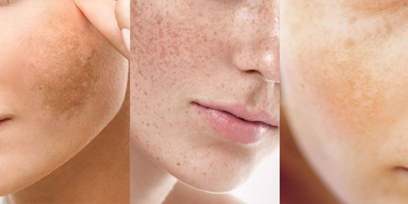 Các phương pháp trị nám da mặt theo 3 cấp độ nghiêm trọng   