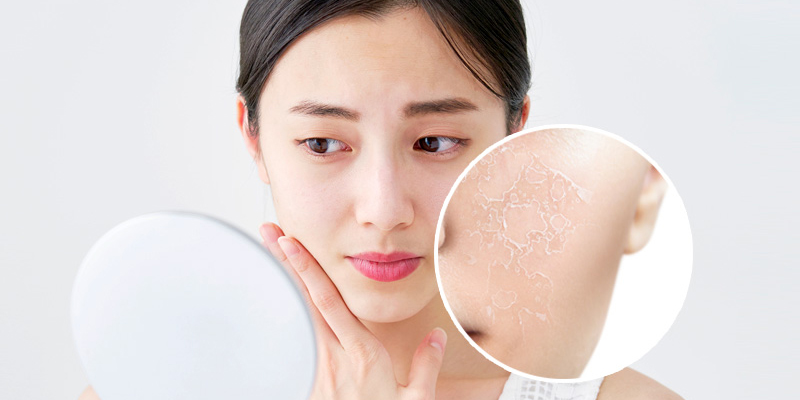 Should You Get Laser Treatment for Melasma? What are Benefits, Side Effects & Best Alternatives 2 Laser Therapy for Melasma