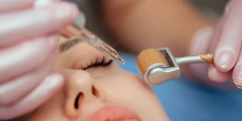 Should You Get Laser Treatment for Melasma? What are Benefits, Side Effects & Best Alternatives 3 Microneedling for melasma