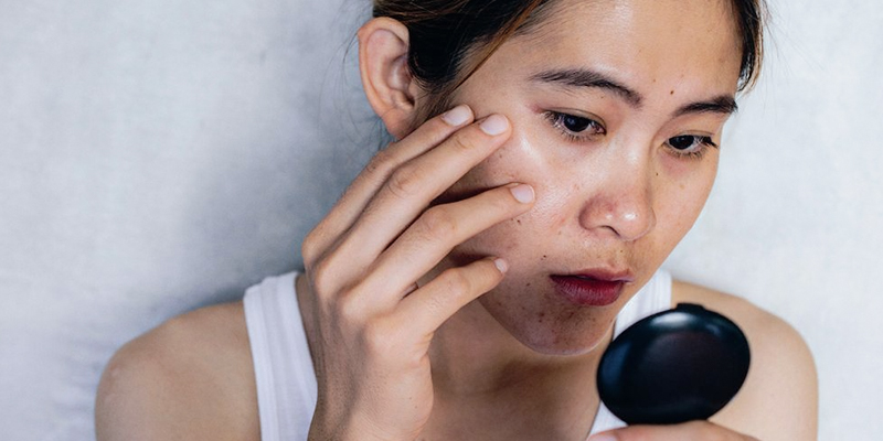 What Is a Melasma Mustache? Causes, Symptoms & How to Get Rid of It 3 What Causes Upper Lip Melasma