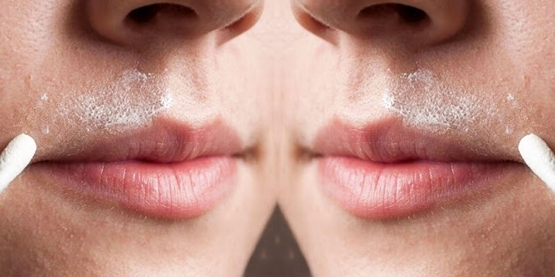 What Is a Melasma Mustache? Causes, Symptoms & How to Get Rid of It 4 How To Get Rid Of Dark Skin Above Upper Lip