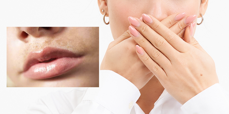 What Is a Melasma Mustache? Causes, Symptoms & How to Get Rid of It 1 What Is a Melasma Mustache?