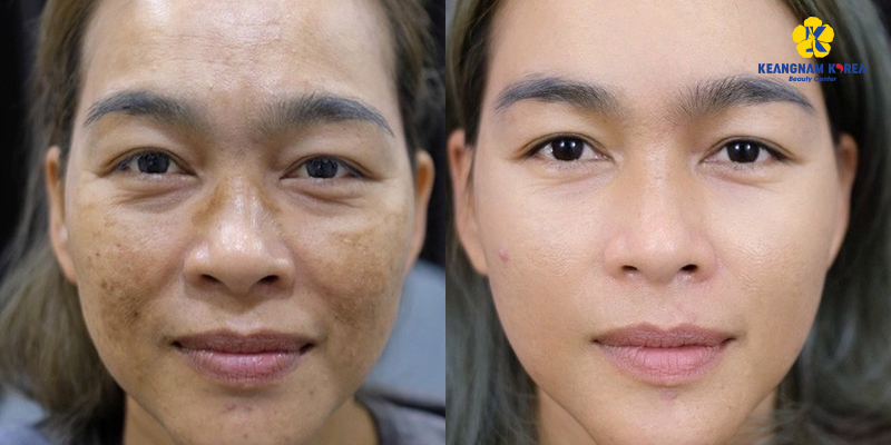 Mesotherapy for Melasma in Ho Chi Minh City: Cost, Sessions Needed & Why Choose Keangnam Korea 3 Mesotherapy for Melasma in Ho Chi Minh City