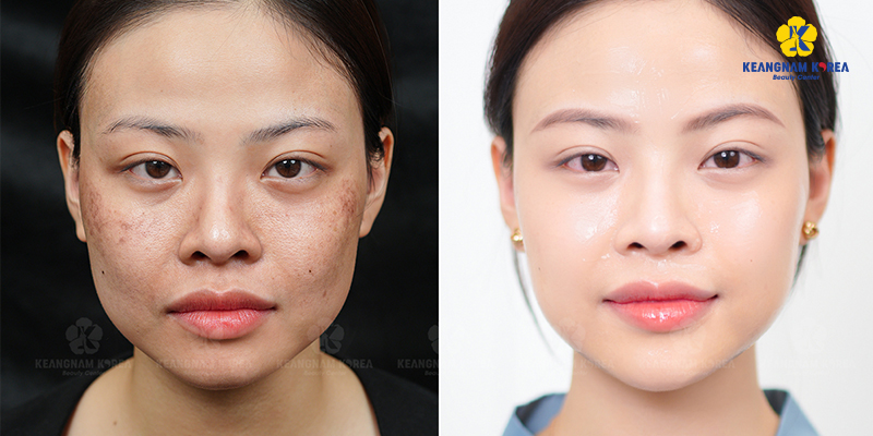 Mesotherapy for Melasma in Ho Chi Minh City: Cost, Sessions Needed & Why Choose Keangnam Korea 4 Mesotherapy for Melasma in Ho Chi Minh City
