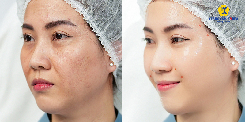 So sánh 2 phương pháp trị nám da mặt tại Keangnam Korea   