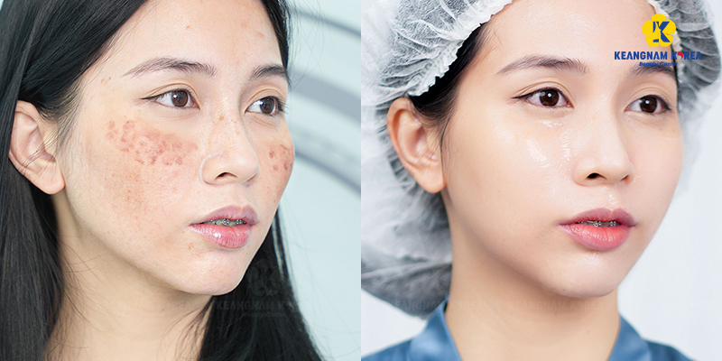 So sánh 2 phương pháp trị nám da mặt tại Keangnam Korea   