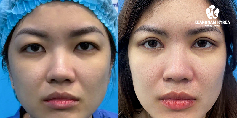 5 Types of Blepharoplasty in Vietnam: The A-Z Guide to Eye Rejuvenation Surgery 7 Canthoplasty