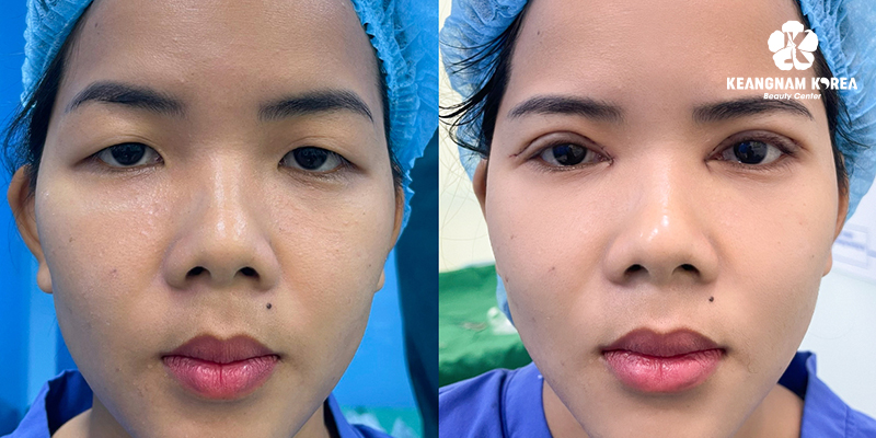 5 Types of Blepharoplasty in Vietnam: The A-Z Guide to Eye Rejuvenation Surgery 6 Canthoplasty