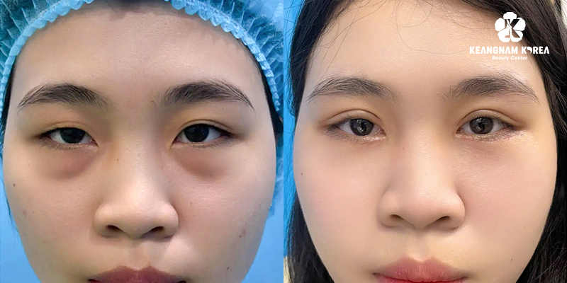 Best Clinic for Eyelid Surgery in Vietnam: The 2026 Guide to Choosing Safely 5 best clinic eyelid surgery vietnam