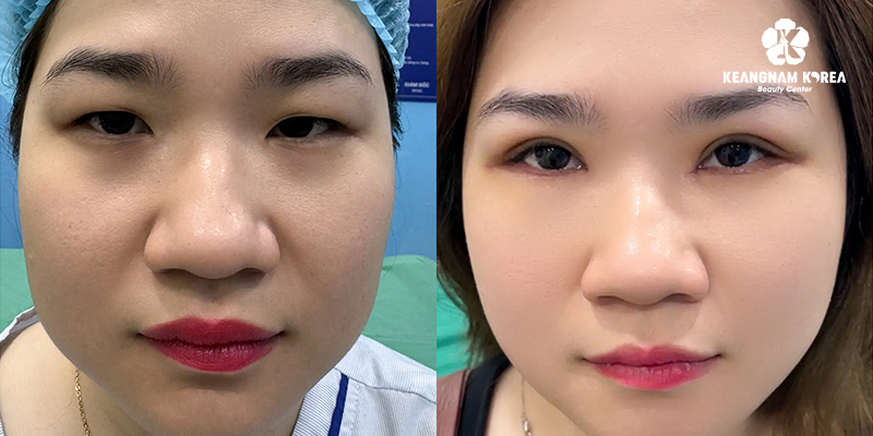 Best Clinic for Eyelid Surgery in Vietnam: The 2026 Guide to Choosing Safely 6 best clinic eyelid surgery vietnam