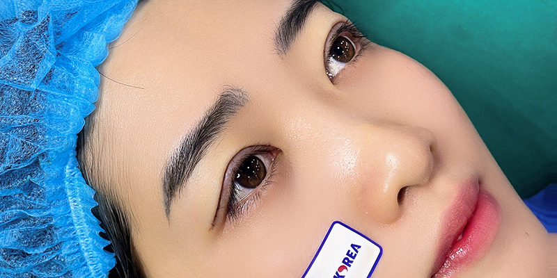 5 Types of Blepharoplasty in Vietnam: The A-Z Guide to Eye Rejuvenation Surgery 3 Double Blepharoplasty