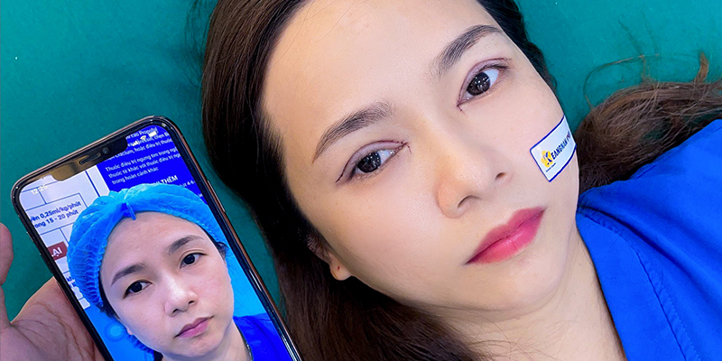 5 Types of Blepharoplasty in Vietnam: The A-Z Guide to Eye Rejuvenation Surgery 2 Double Eyelid Surgery