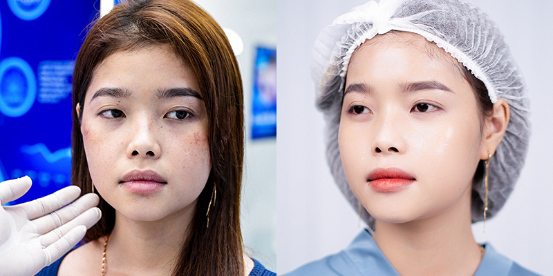 HA Skin Booster Injection vs Exosome Mesotherapy Injection: Which Is Better for Plump, Glowing Skin? 2 What Are Mesotherapy Injections