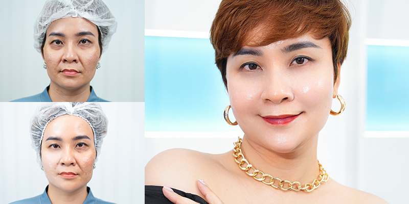 HA Skin Booster Injection vs Exosome Mesotherapy Injection: Which Is Better for Plump, Glowing Skin? 4 Which Should You Choose: Exosome or HA Skin Booster