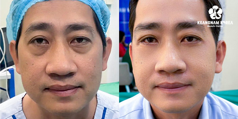 5 Types of Blepharoplasty in Vietnam: The A-Z Guide to Eye Rejuvenation Surgery 9 Eye Bag Removal