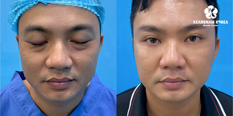 5 Types of Blepharoplasty in Vietnam: The A-Z Guide to Eye Rejuvenation Surgery 8 Lower Blepharoplasty