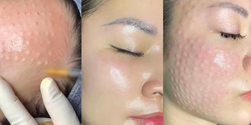 Non-Surgical Skin Tightening: Top 4 injectables, Pros and Cons to Know Before Treatment 5 4 Skin Boosting Injectables for Non-Surgical Skin Tightening