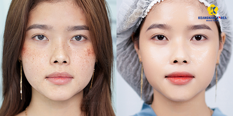 Non-Surgical Skin Tightening: Top 4 injectables, Pros and Cons to Know Before Treatment 6 4 Skin Boosting Injectables for Non-Surgical Skin Tightening