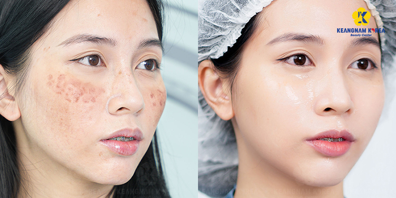 Non-Surgical Skin Tightening: Top 4 injectables, Pros and Cons to Know Before Treatment 7 4 Skin Boosting Injectables for Non-Surgical Skin Tightening