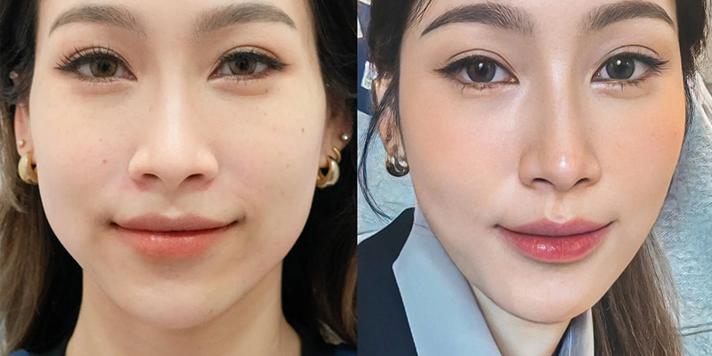 PRP Injection for Glowing Skin: Is It Worth It & How Long Do Results Last? 2 What Does PRP Facial Treatment Actually Do