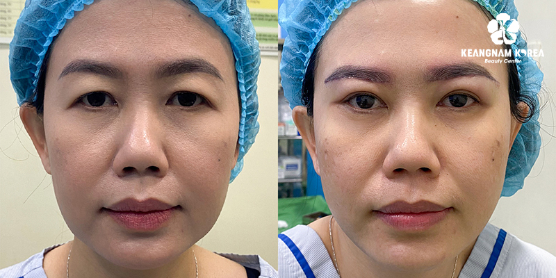 5 Types of Blepharoplasty in Vietnam: The A-Z Guide to Eye Rejuvenation Surgery 4 Advanced Brow Lift