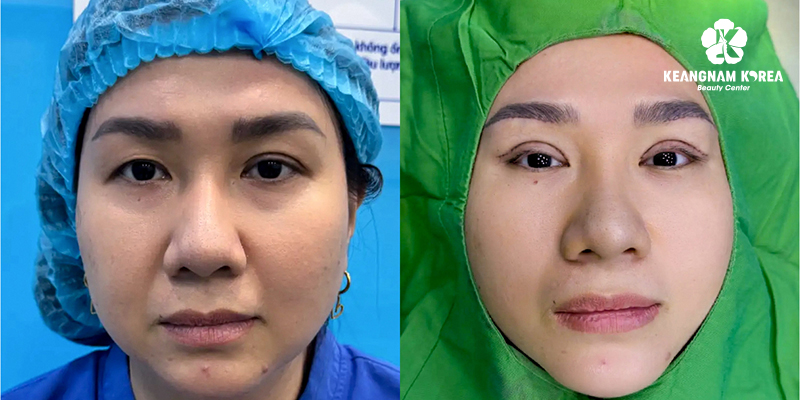 5 Types of Blepharoplasty in Vietnam: The A-Z Guide to Eye Rejuvenation Surgery 5 Advanced Brow Lift