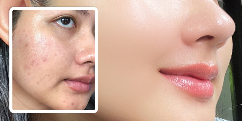 Needle-Free Mesotherapy vs. Traditional Injections: Mechanism, Clinical Benefits, and Structural Differences 4 Needle-Free Mesotherapy vs. Traditional Injections