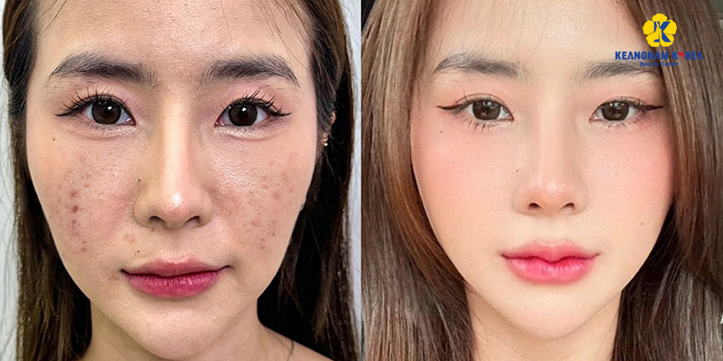 Needleless Mesotherapy vs Traditional Mesotherapy: Which Is Better for Your Face? 5 Needleless Mesotherapy at ho chi minh