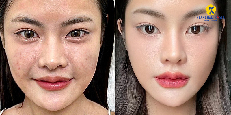 Needleless Mesotherapy vs Traditional Mesotherapy: Which Is Better for Your Face? 4 Needleless Mesotherapy before and after