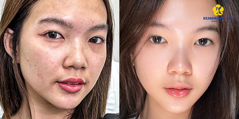 Needleless Mesotherapy vs Traditional Mesotherapy: Which Is Better for Your Face? 6 Mesotherapy at keangnam korea