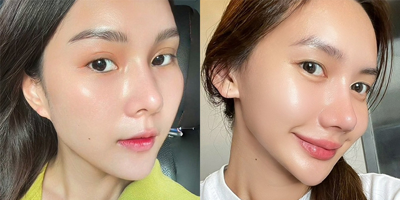 Needleless Mesotherapy vs Traditional Mesotherapy: Which Is Better for Your Face? 1 Needleless Mesotherapy vs Traditional Mesotherapy