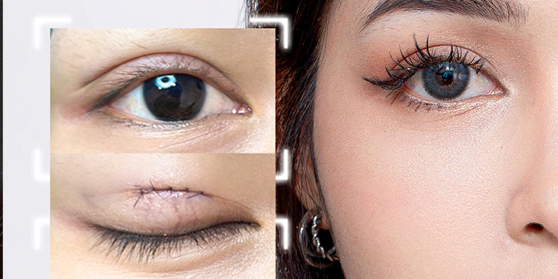 How to Get Bigger Eyes Permanently? 3 surgery for bigger eyes options and cost 3 surgery for bigger eyes
