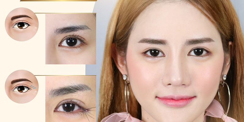 How to Get Bigger Eyes Permanently? 3 surgery for bigger eyes options and cost 4 surgery for bigger eyes