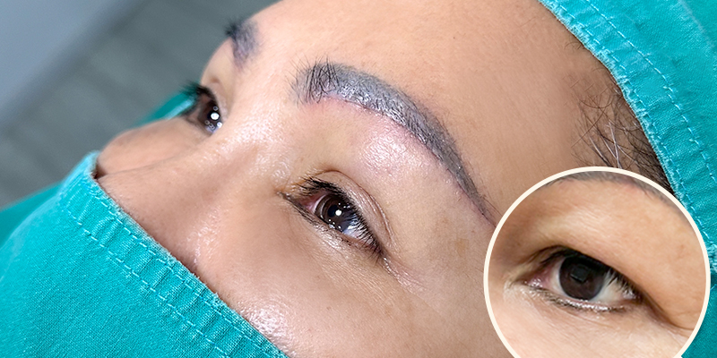 How to Get Bigger Eyes Permanently? 3 surgery for bigger eyes options and cost 5 surgery for bigger eyes