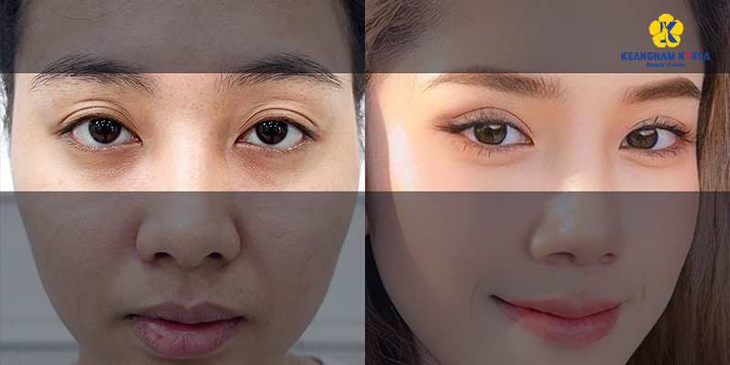 How to Get Bigger Eyes Permanently? 3 surgery for bigger eyes options and cost 7 surgery for bigger eyes