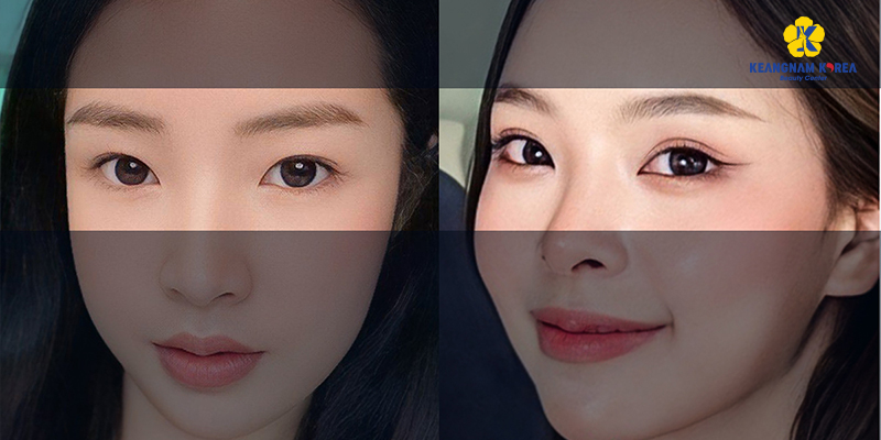 How to Get Bigger Eyes Permanently? 3 surgery for bigger eyes options and cost 8 surgery for bigger eyes