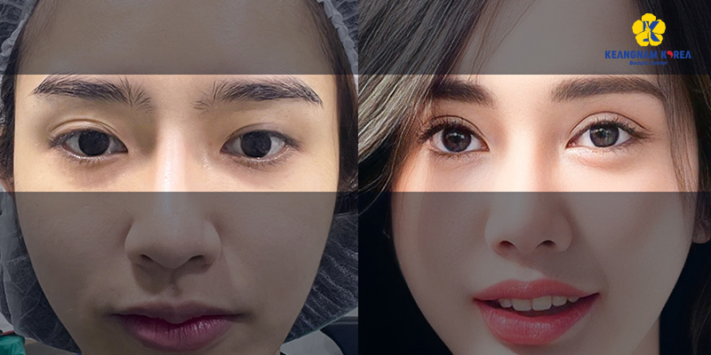 How to Get Bigger Eyes Permanently? 3 surgery for bigger eyes options and cost 9 surgery for bigger eyes