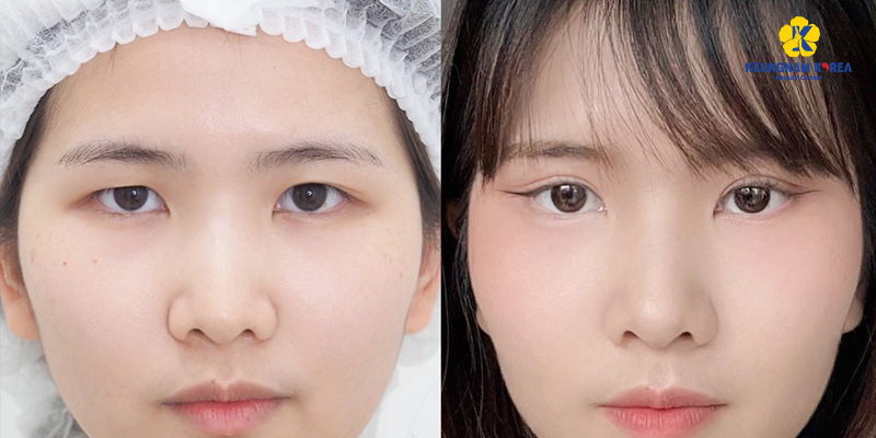 Upturned Eyes: What They Are, Good or Bad, and How to Fix Them 3 Upturned Eyes surgery