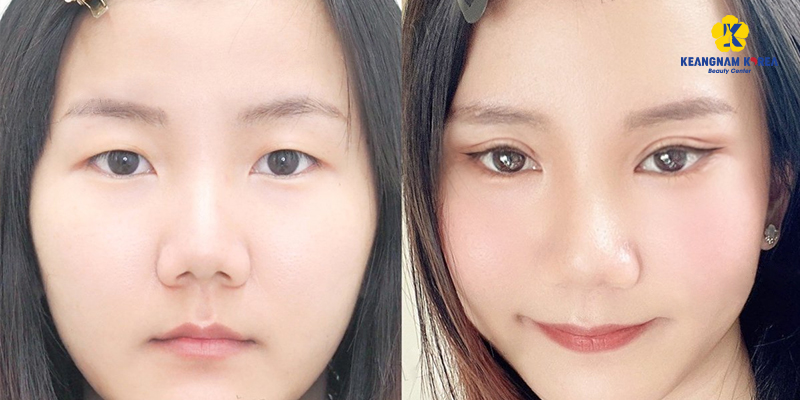 Upturned Eyes: What They Are, Good or Bad, and How to Fix Them 4 Upturned Eyes before and after