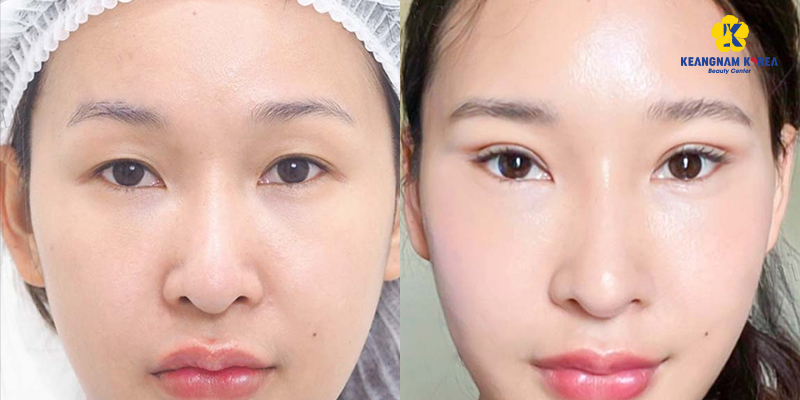 Upturned Eyes: What They Are, Good or Bad, and How to Fix Them 5 Upturned Eyes cost